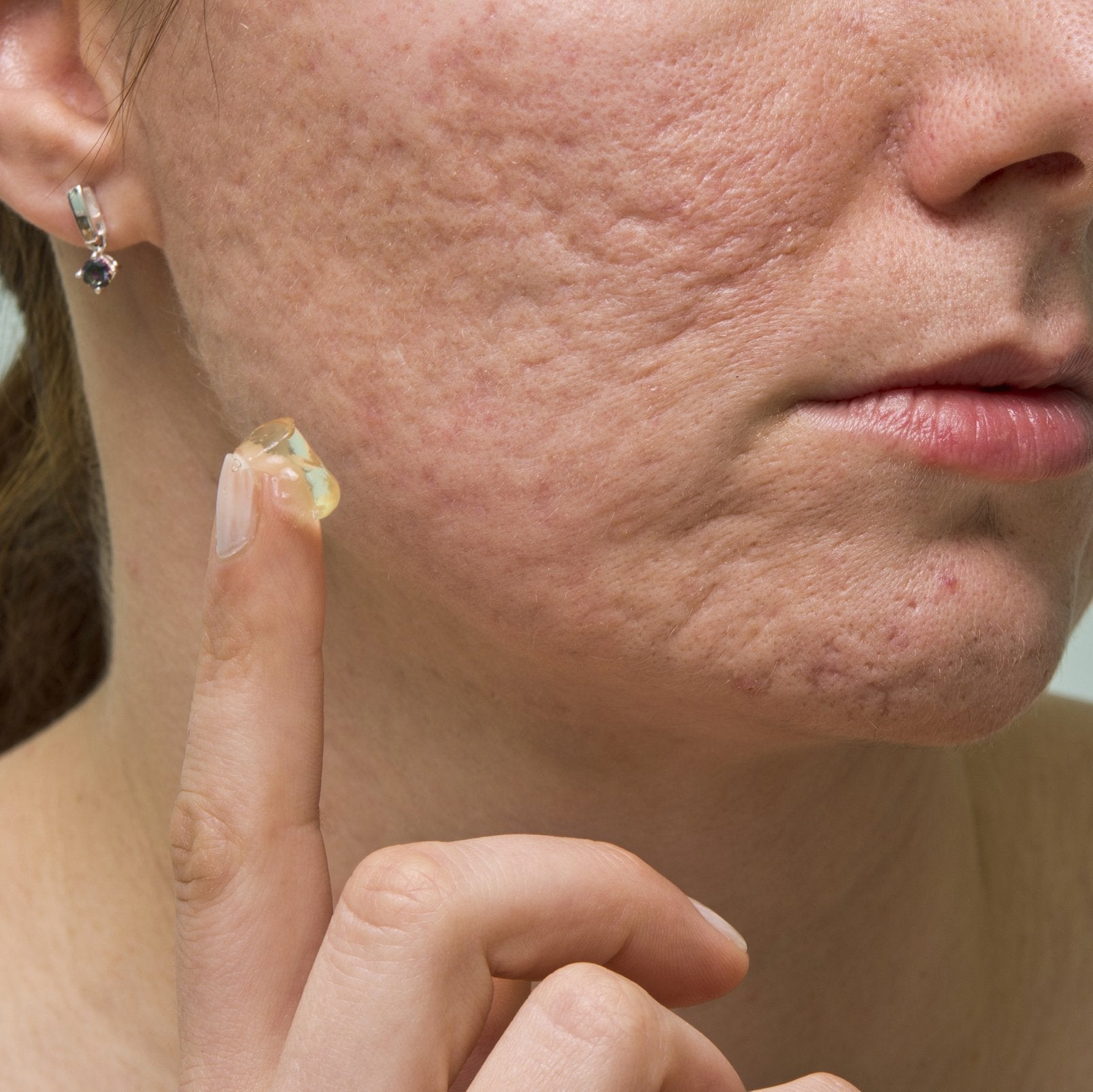 TCM Acne Scar Cream - Mounteen. Worldwide shipping available.