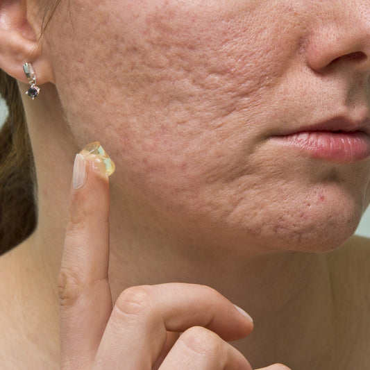 TCM Acne Scar Cream - Mounteen. Worldwide shipping available.